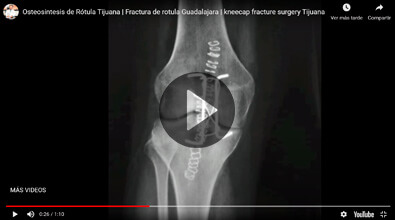 Lesión de Rodilla - Traumatólogo y Ortopedista